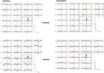 Walking-Related Dual-Task Interference in Early-to-Middle-Stage Huntington's Disease: An Auditory Event Related Potential Study